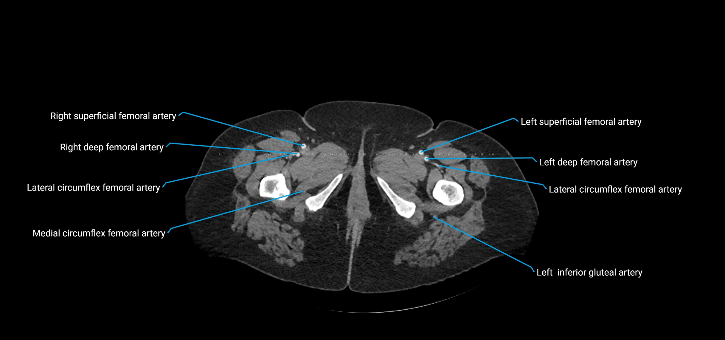 CTA abdomen axial cross sectional anatomy labelled image_283 (2).webp